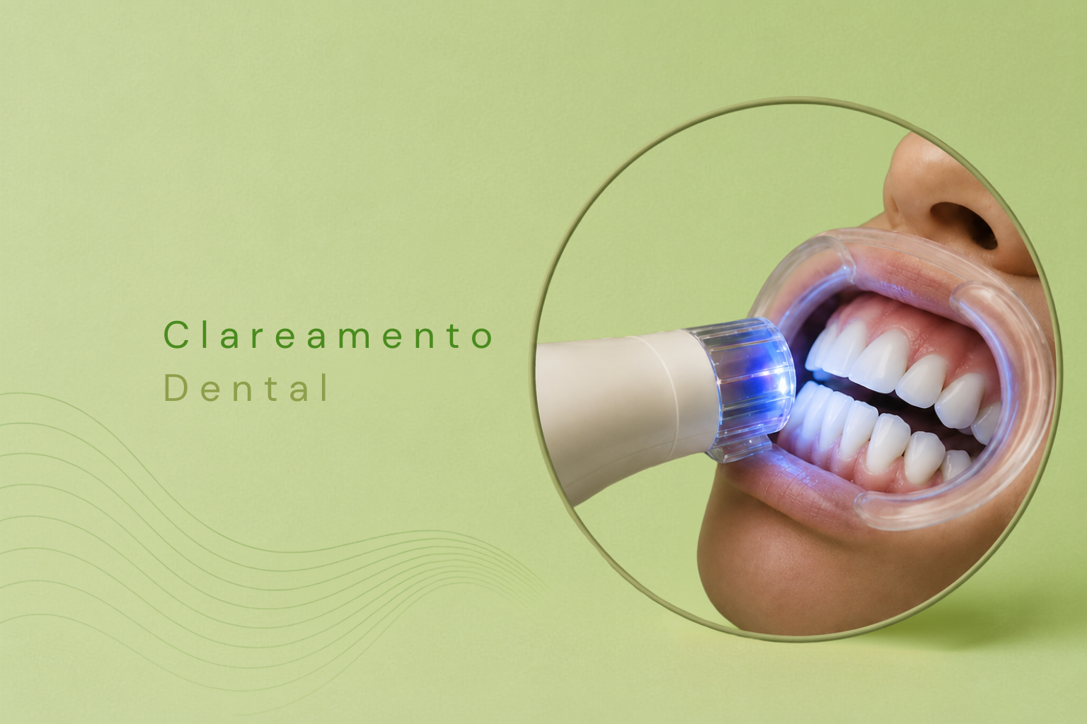 Clareamento Dental

O clareamento dental é um procedimento estético que tem como objetivo tornar os dentes mais claros, melhorando a aparência do sorriso.

Ao longo do tempo, os dentes podem apresentar alterações de cor relacionadas a diversos fatores, como alimentação, consumo frequente de café e vinho, tabagismo, envelhecimento, alguns medicamentos, fluorose e alterações decorrentes de tratamentos odontológicos.

Clareamento em Consultório

O clareamento realizado em consultório é acompanhado diretamente pelo cirurgião-dentista e utiliza agentes clareadores em concentrações adequadas para esse tipo de procedimento.

Antes de iniciar o tratamento, é realizada uma avaliação da saúde bucal para verificar as condições dos dentes e da gengiva e identificar possíveis alterações que necessitem de tratamento prévio.

Durante o procedimento, é realizada a proteção dos tecidos gengivais e a aplicação do gel clareador sobre os dentes, seguindo o protocolo indicado para cada paciente.

O número de sessões e o grau de clareamento alcançado podem variar de acordo com as características individuais, a tonalidade inicial dos dentes e a resposta de cada paciente ao tratamento.

Clareamento Caseiro Supervisionado

O clareamento caseiro supervisionado é realizado pelo próprio paciente em casa, mas sempre com indicação, planejamento e acompanhamento do cirurgião-dentista.

São confeccionadas moldeiras personalizadas para a aplicação do gel clareador, que deve ser utilizado na quantidade, frequência e pelo período determinados pelo profissional.

Antes de iniciar o tratamento, é importante que a saúde bucal esteja em condições adequadas. A presença de cáries, alterações gengivais, sensibilidade ou outros problemas deve ser avaliada pelo dentista.

Qual técnica é mais indicada?

A escolha entre o clareamento realizado em consultório, o caseiro supervisionado ou a associação das técnicas depende das características e necessidades de cada paciente.

Por isso, uma avaliação odontológica é fundamental para definir a técnica mais adequada e realizar o clareamento com acompanhamento profissional.
