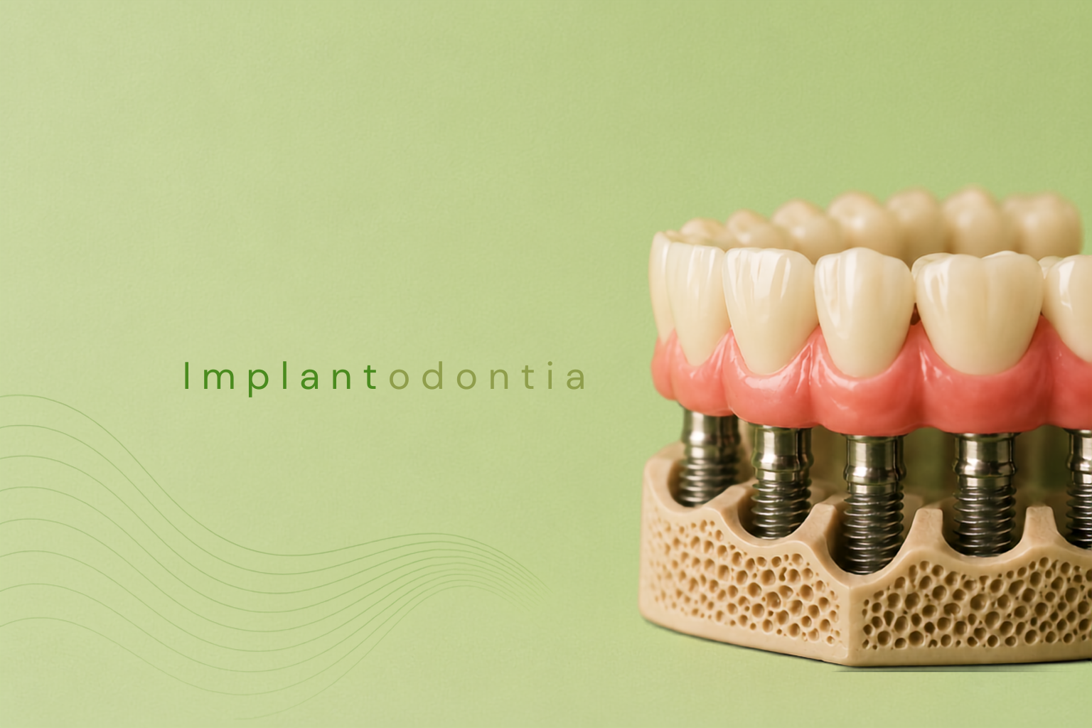 Implante dentário

Os implantes ósseo integrados estão cada vez mais previsíveis, hoje é impossível planejar a reabilitação oral de um paciente sem contar com esta técnica. São pequenos parafusos de titânio utilizados para substituir um ou mais dentes que se perderam.

Etapas para a Instalação dos Implantes:

1 - Cirurgia para colocação do implante
2 - Implante colocado
3 - Colocação do dente (coroa)

1 - O que é implante dentário?
É um componente de titânio colocado dentro da maxila ou mandíbula para suporte posterior da prótese.

2 - A cirurgia é complicada ou dolorosa?
Absolutamente NÃO. Anestesia local, procedimento rápido e pós operatório sem maiores transtornos.

Amplie sua qualidade de vida investindo em seu sorriso

Reabilitação oral e implantes
Atualmente, com as tecnologias de última geração, o cirurgião dentista, consegue com o uso dos implantes dentários, reabilitar os dentes perdidos com conforto e segurança. Possuímos conhecimentos técnicos e tecnologia para devolver a condição mastigatória, o conforto para falar, a estética do sorriso e consequentemente a autoestima dos pacientes que sofrem com a perda de dentes e que sonham em voltar a mastigar e sorrir naturalmente.

Carga Imediata
Hoje já é possível a colocação de implantes e as coroas (próteses) de imediato, ou seja, sem a necessidade de um tempo de cicatrização dos implantes.

Protocolo de carga imediata
Em determinados casos pode ser feita a extração de dentes condenados, a colocação de 4 a 6 implantes e a confecção de uma prótese fixa com 12 dentes.

Overdenture
Com a colocação de 2 a 4 implantes é possível eliminar o desconforto causado na constante mobilidade das próteses parciais ou totais.